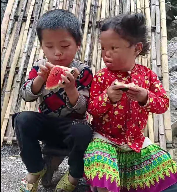 Cấp bách! Giúp đỡ trẻ bị bỏng sâu