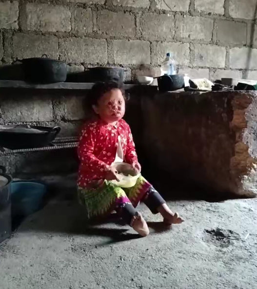 Cấp bách! Giúp đỡ trẻ bị bỏng sâu