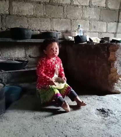 Cấp bách! Giúp đỡ trẻ bị bỏng sâu