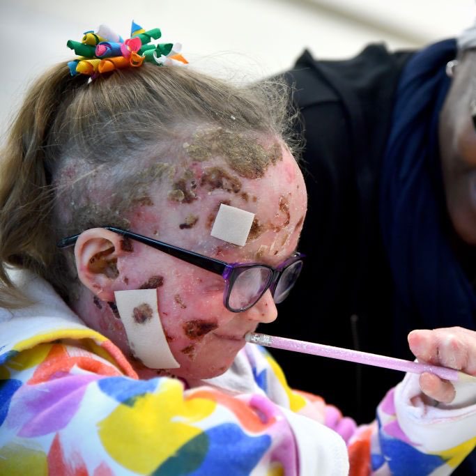 Epidermolysis Bullosa Charity, Your Donations Save Lives