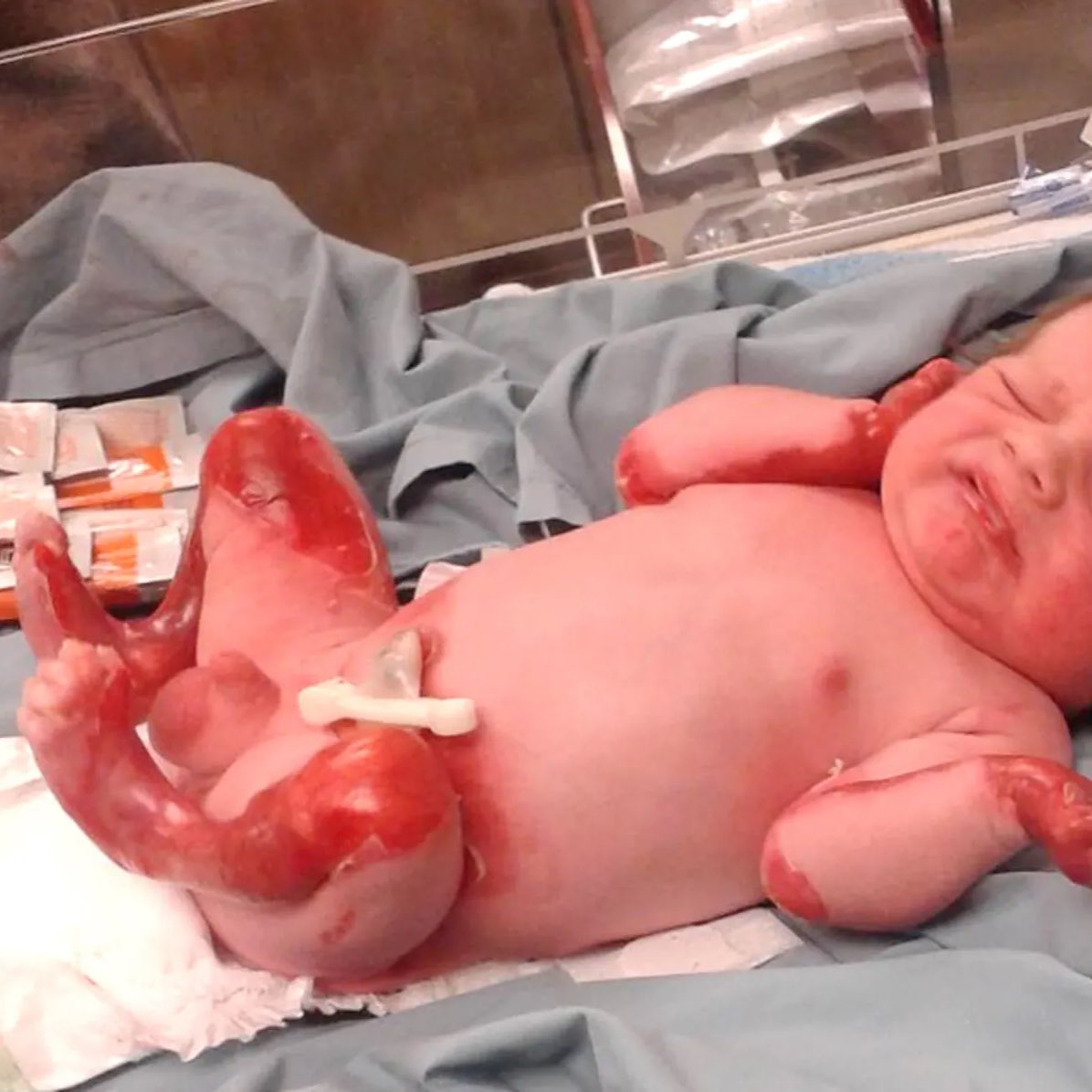 Epidermolysis Bullosa Charity, Your Donations Save Lives