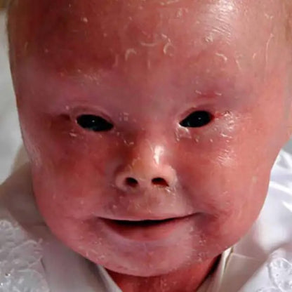 Rescue Ichthyosis Patients - Giving Hope To Life