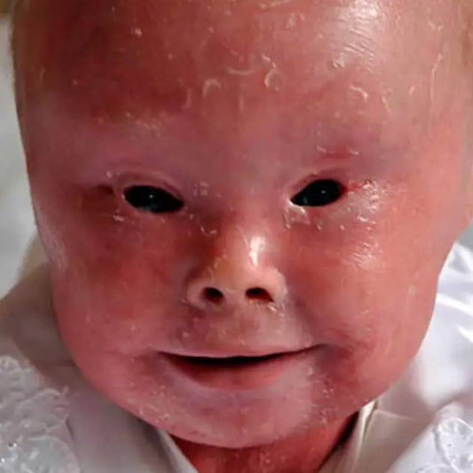 Rescue Ichthyosis Patients - Giving Hope To Life