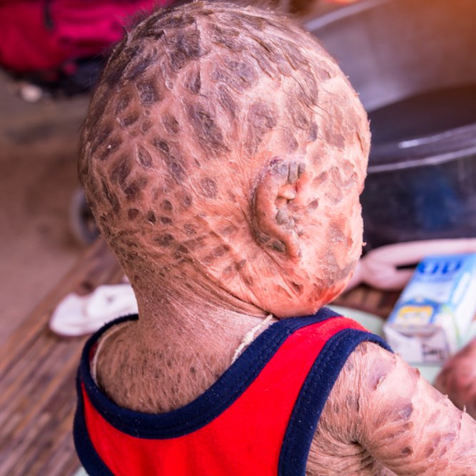 Rescue Ichthyosis Patients - Giving Hope To Life