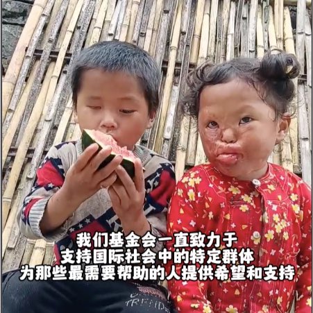 Urgent! Helping Children With Deep Burns