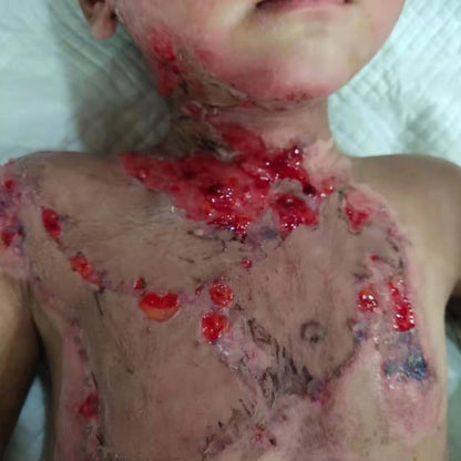 Urgent! Helping Children With Deep Burns